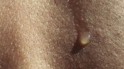 Anhidrosis - nesposobnost tijela da proizvodi znoj