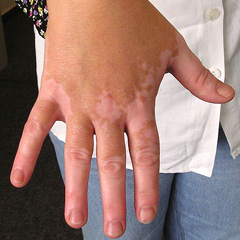 Šta je to vitiligo? Šta je to vitiligo?