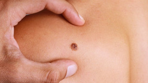 5 simptoma raka kože na koje trebate obratiti pažnju