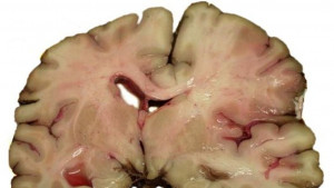 Manjak željeza povećava rizik od moždanog udara