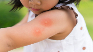 Kako spriječiti ubode komaraca dok spavate?