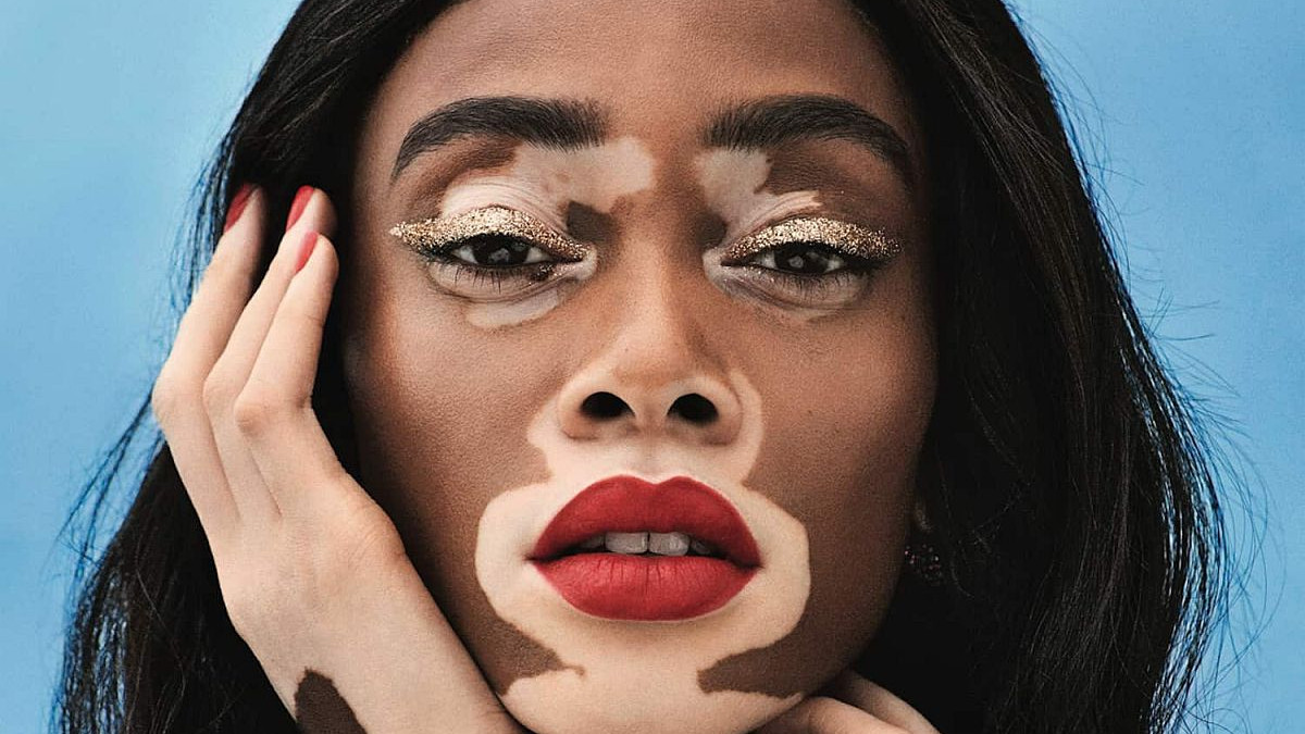 Manekenka s vitiligom koja pomjera granice modne industrije