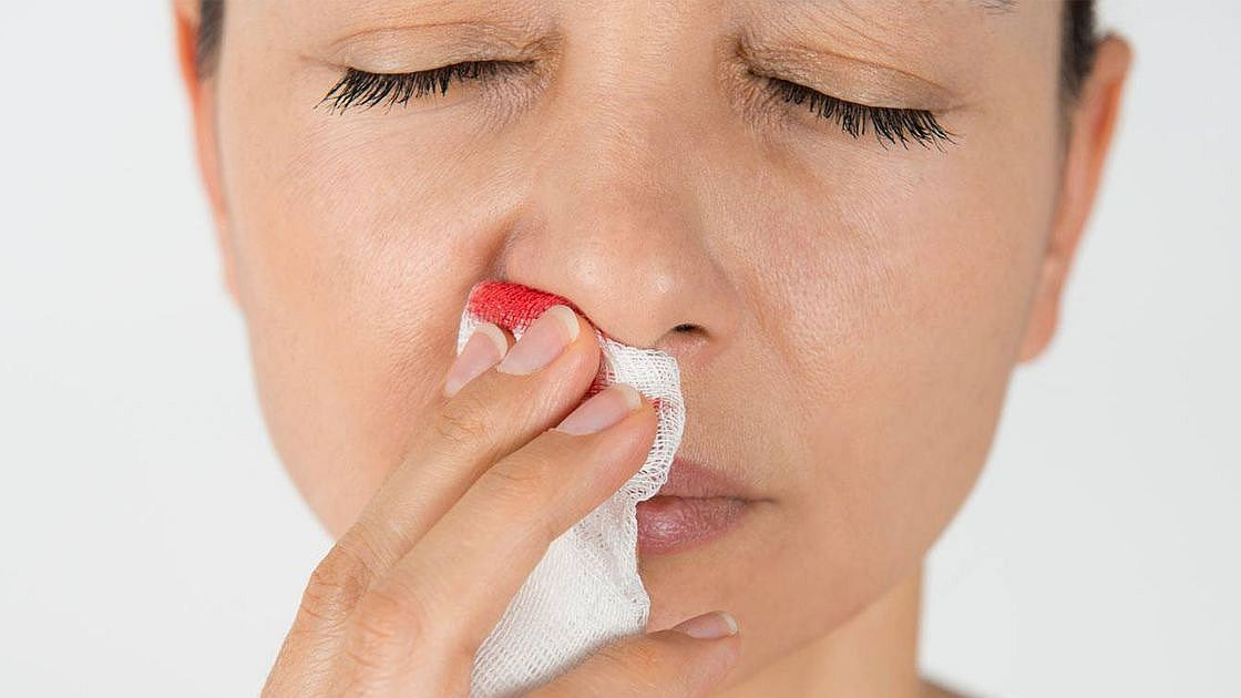 Kako zaustaviti krvarenje nosa?