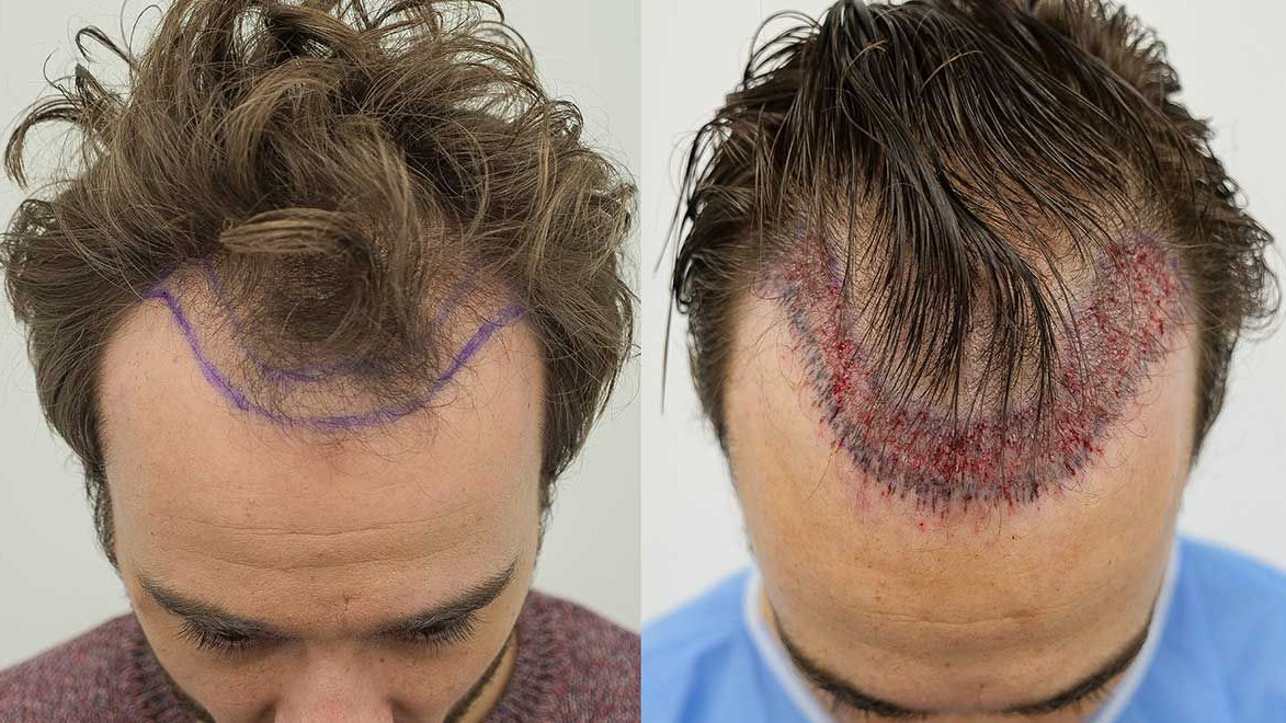 Boom za samopouzdanje: Transplantacija kose