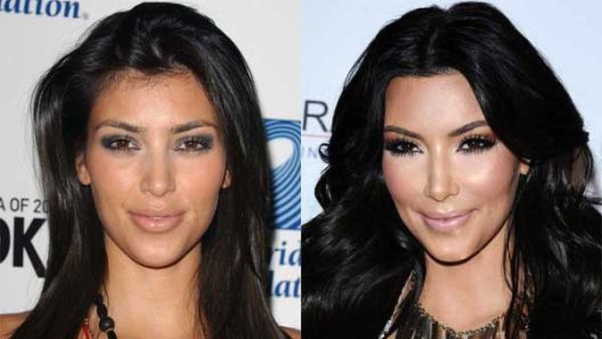 Kim Kardashian i sve plastične operacije