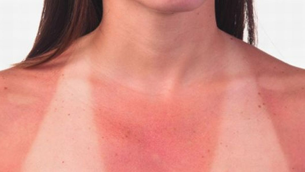 Kako pomoći koži izgorjeloj na suncu? Kako pomoći koži izgorjeloj na suncu?