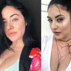 Model sa aknama: Starlie ohrabrila druge djevojke Model sa aknama: Starlie ohrabrila druge djevojke
