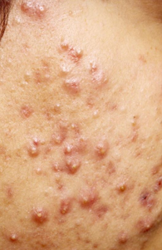 Od mitisera do čvorova i akni, 6 različitih pojava Od mitisera do čvorova i akni, 6 različitih pojava