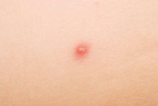 Od mitisera do čvorova i akni, 6 različitih pojava Od mitisera do čvorova i akni, 6 različitih pojava