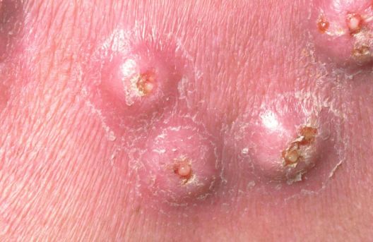 Od mitisera do čvorova i akni, 6 različitih pojava Od mitisera do čvorova i akni, 6 različitih pojava