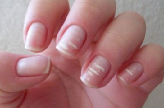 8 znakova tijela da se bori sa deficitom proteina