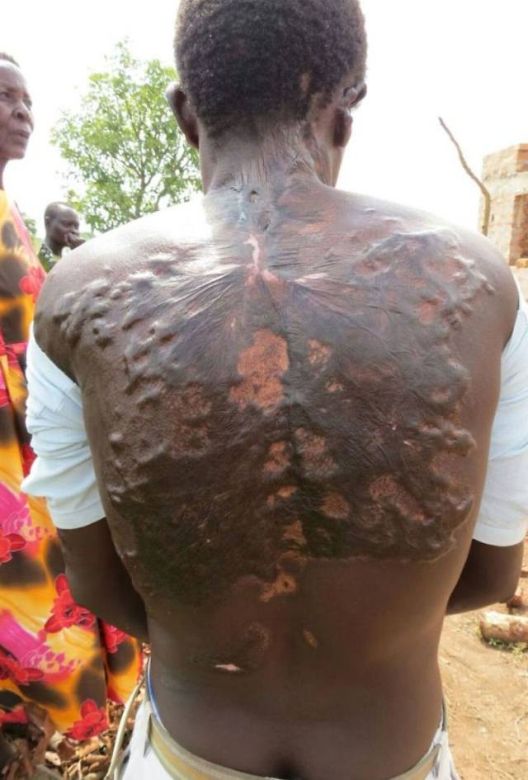 Kako izgleda tijelo ljudi nakon udara groma?