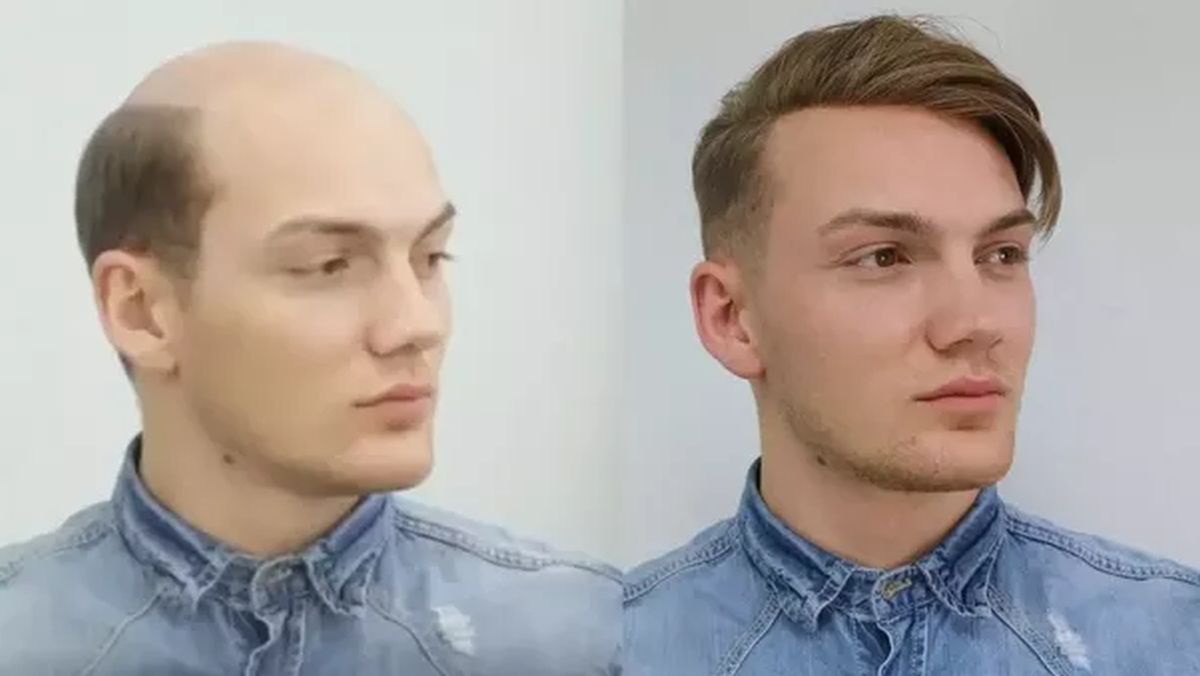 Kako izbjeći opadanje kose Kako izbjeći opadanje kose