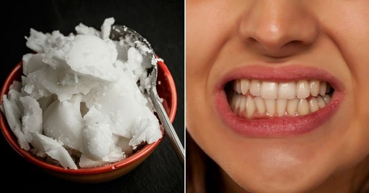 Prirodni načini da izbijelite zube