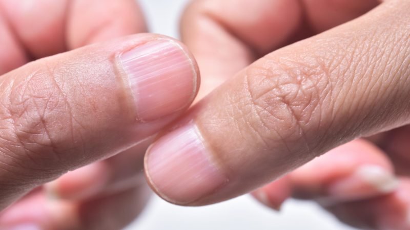 Evo šta vam vaši nokti govore o zdravlju