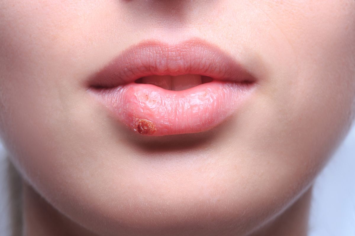 Ako primijetite ove simptome u ustima, obavezno se posavjetujte sa doktorom