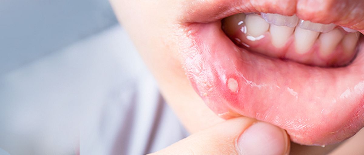 Ako primijetite ove simptome u ustima, obavezno se posavjetujte sa doktorom